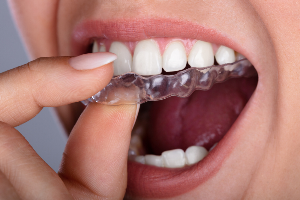 Patient inserting clear aligners for discreet teeth straightening