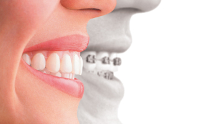 Clear aligners compared with traditional braces treatment