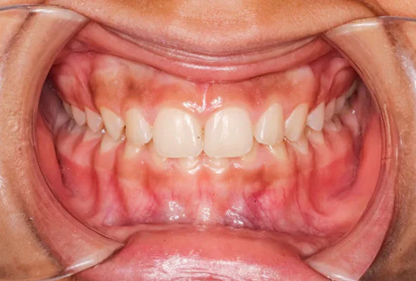 Crowded teeth case suitable for clear aligner treatment