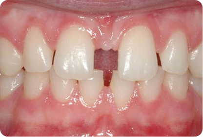Gap between front teeth suitable for aligner correction