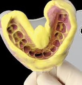 Dental impression model for custom aligner fabrication